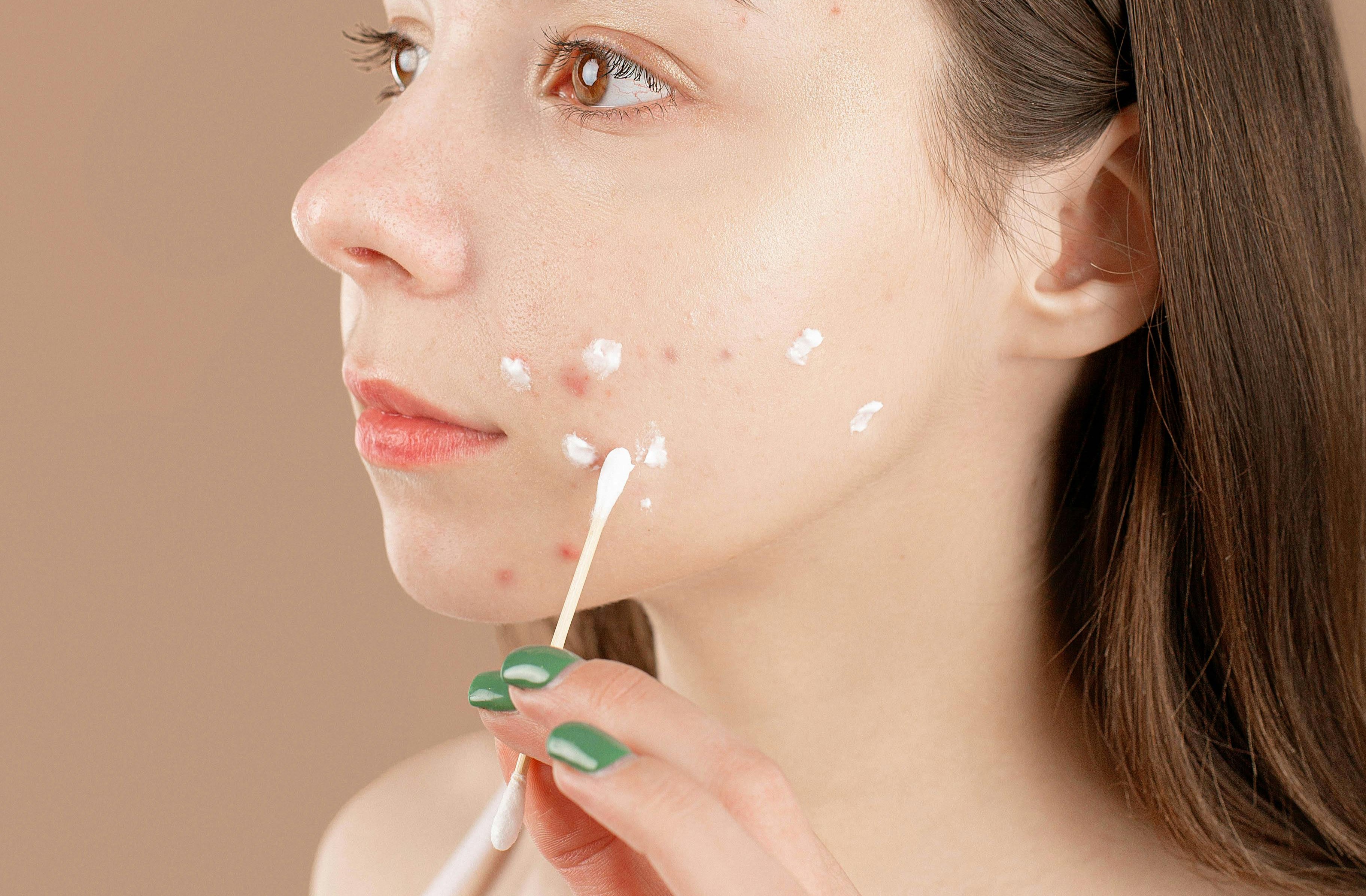 Acne Solutions